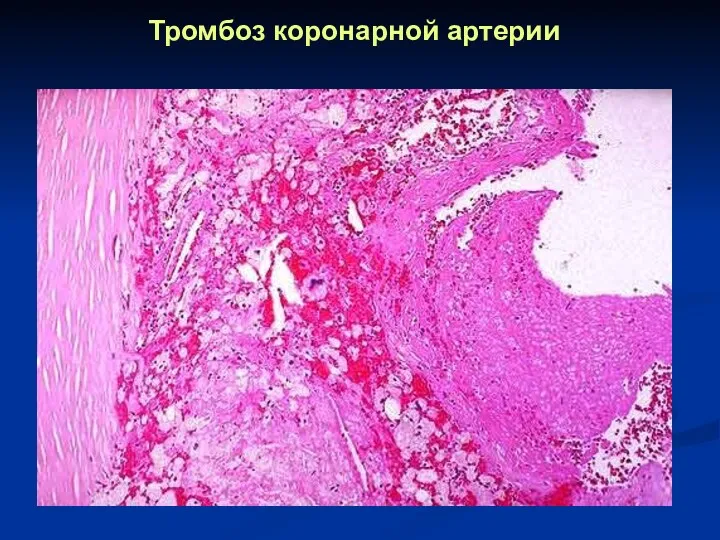 Тромбоз коронарной артерии