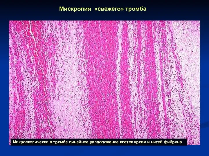 Мискропия «свежего» тромба Микроскопически в тромбе линейное расположение клеток крови и нитей фибрина