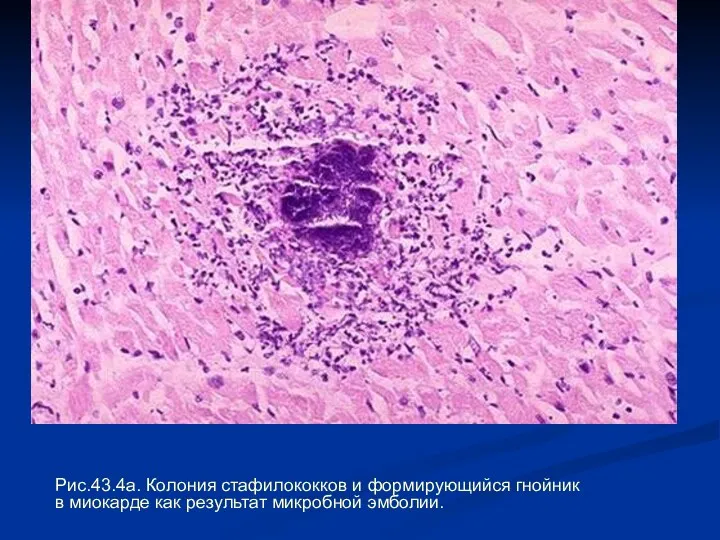 Рис.43.4а. Колония стафилококков и формирующийся гнойник в миокарде как результат микробной эмболии.