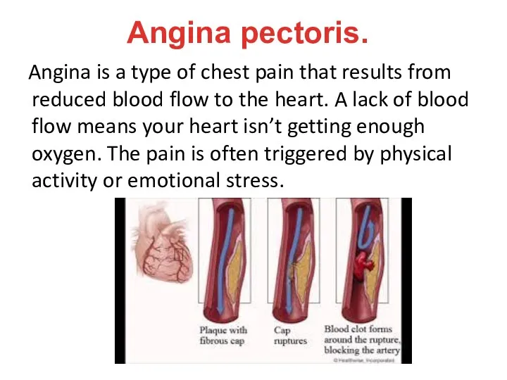 Angina pectoris. Angina is a type of chest pain that