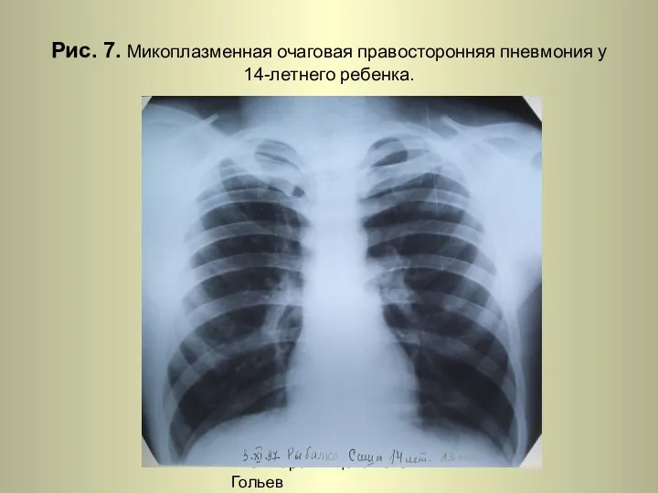 Н.С. Воротынцева. С.С. Гольев Рентгенопульмонология Рис. 7. Микоплазменная очаговая правосторонняя пневмония у 14-летнего ребенка.