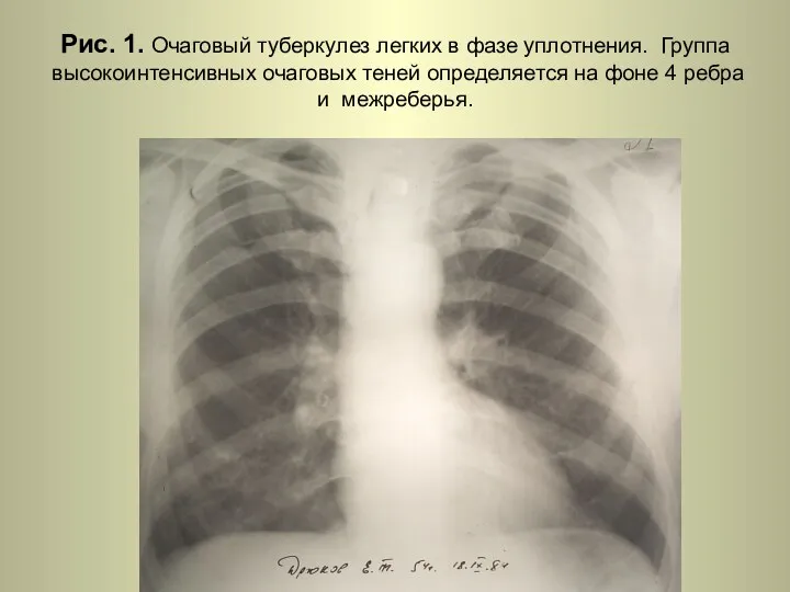 Н.С. Воротынцева. С.С. Гольев Рентгенопульмонология Рис. 1. Очаговый туберкулез легких