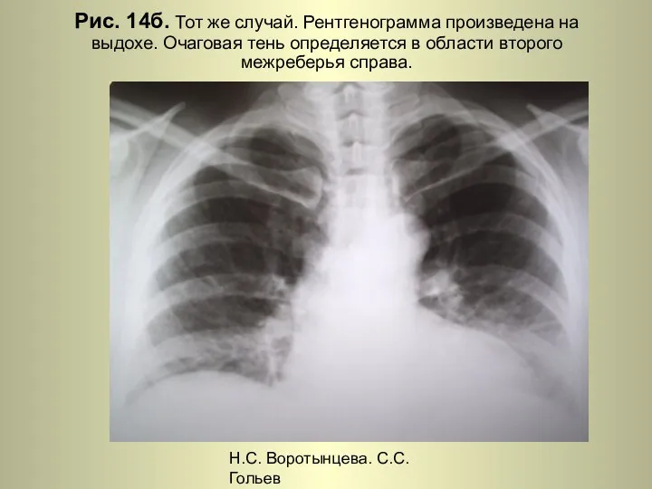 Н.С. Воротынцева. С.С. Гольев Рентгенопульмонология Рис. 14б. Тот же случай. Рентгенограмма произведена на