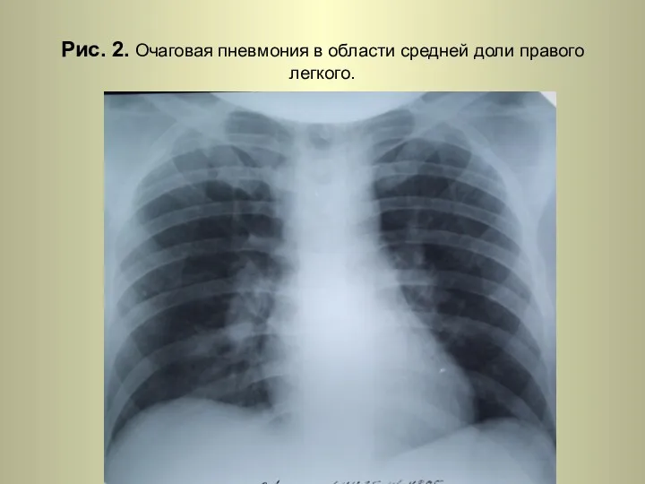 Н.С. Воротынцева. С.С. Гольев Рентгенопульмонология Рис. 2. Очаговая пневмония в области средней доли правого легкого.