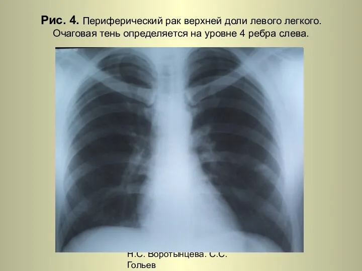 Н.С. Воротынцева. С.С. Гольев Рентгенопульмонология Рис. 4. Периферический рак верхней доли левого легкого.