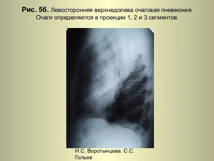 Н.С. Воротынцева. С.С. Гольев Рентгенопульмонология Рис. 5б. Левосторонняя верхнедолева очаговая