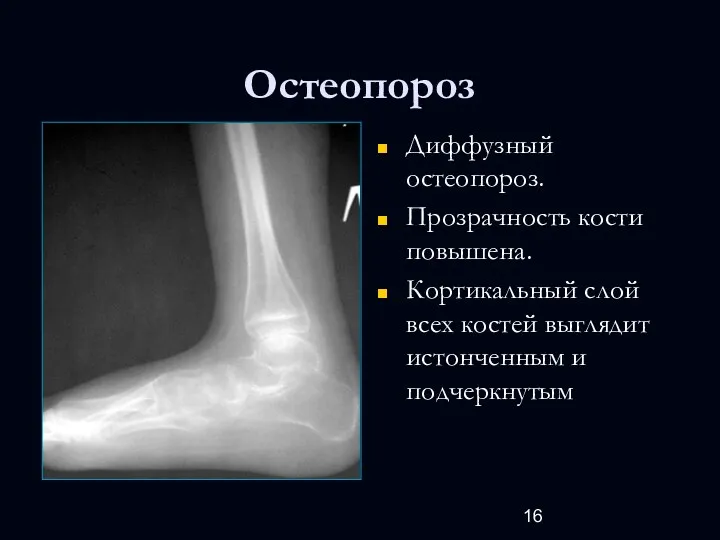 Остеопороз Диффузный остеопороз. Прозрачность кости повышена. Кортикальный слой всех костей выглядит истонченным и подчеркнутым