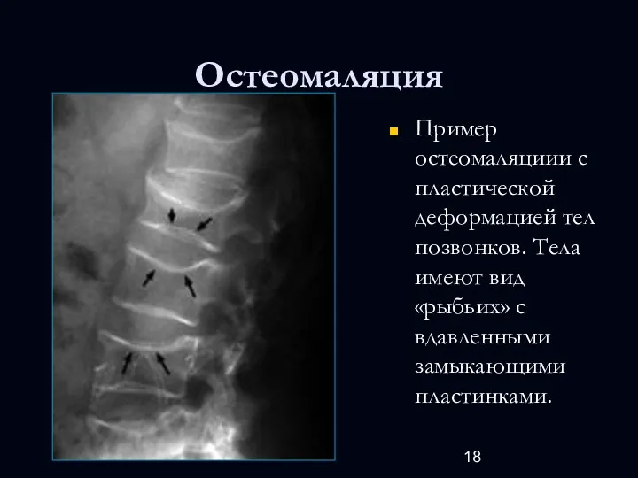 Остеомаляция Пример остеомаляциии с пластической деформацией тел позвонков. Тела имеют вид «рыбьих» с вдавленными замыкающими пластинками.