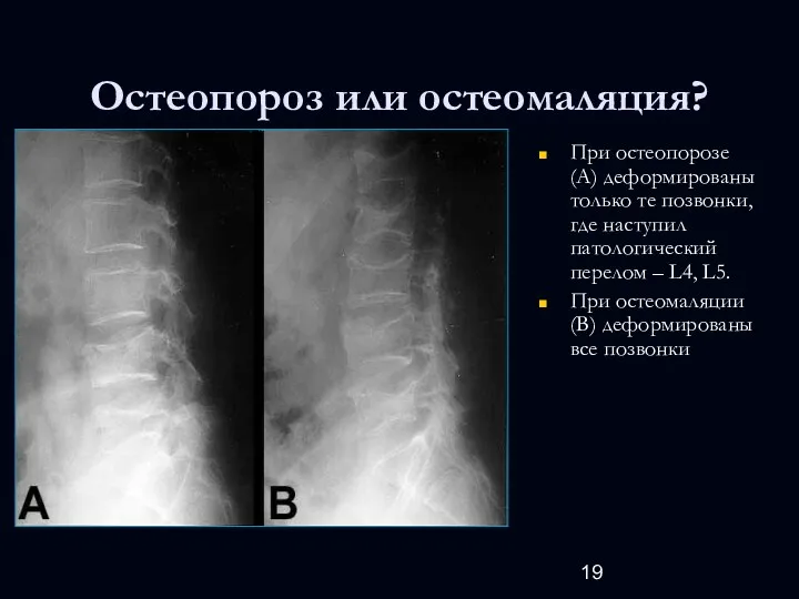 Остеопороз или остеомаляция? При остеопорозе (А) деформированы только те позвонки,