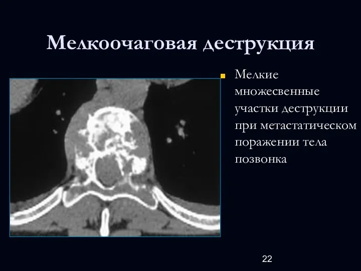 Мелкоочаговая деструкция Мелкие множесвенные участки деструкции при метастатическом поражении тела позвонка