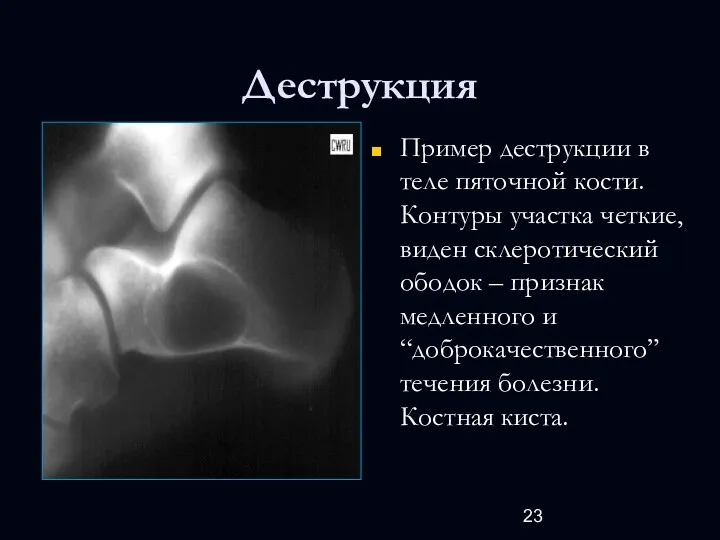 Деструкция Пример деструкции в теле пяточной кости. Контуры участка четкие,