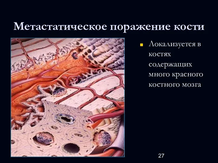 Метастатическое поражение кости Локализуется в костях содержащих много красного костного мозга