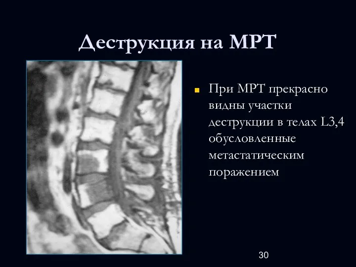 Деструкция на МРТ При МРТ прекрасно видны участки деструкции в телах L3,4 обусловленные метастатическим поражением