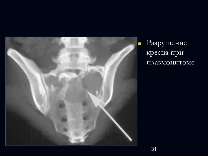 Разрушение кресца при плазмоцитоме