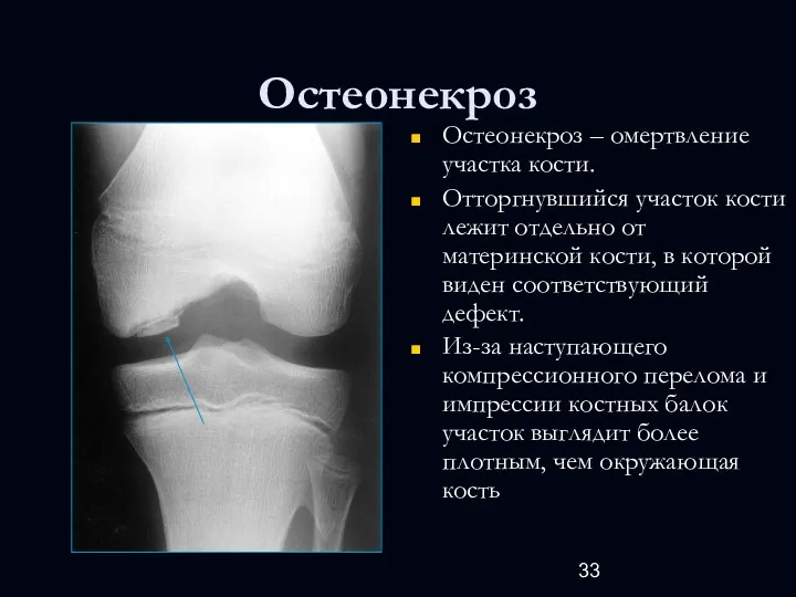 Остеонекроз Остеонекроз – омертвление участка кости. Отторгнувшийся участок кости лежит