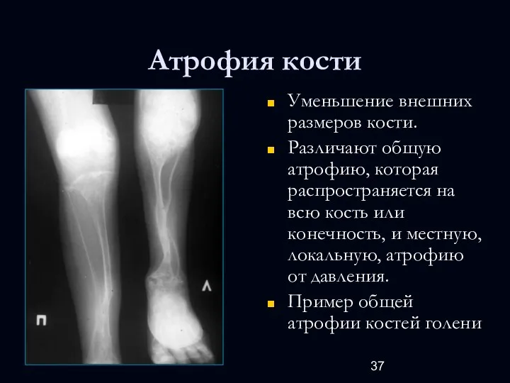 Атрофия кости Уменьшение внешних размеров кости. Различают общую атрофию, которая