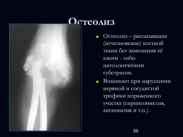 Остеолиз Остеолиз – рассасывание (исчезновение) костной ткани без замещения её