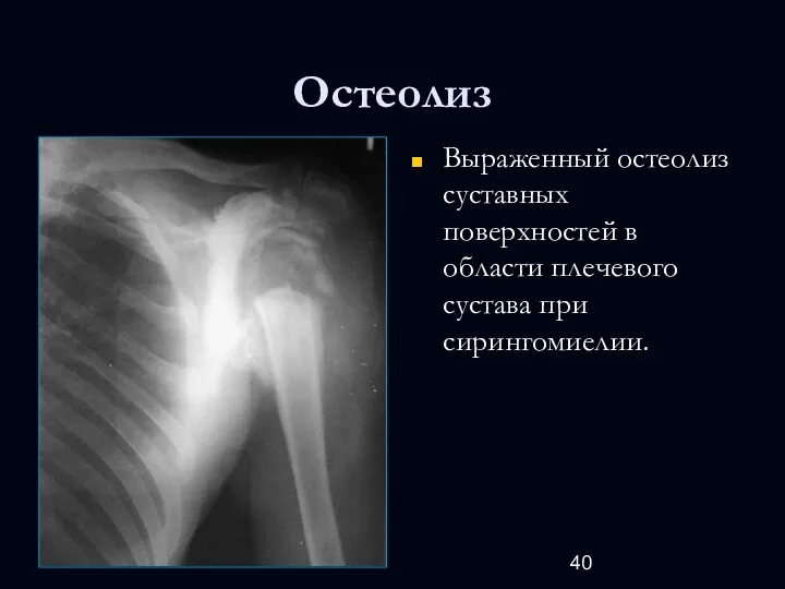 Остеолиз Выраженный остеолиз суставных поверхностей в области плечевого сустава при сирингомиелии.