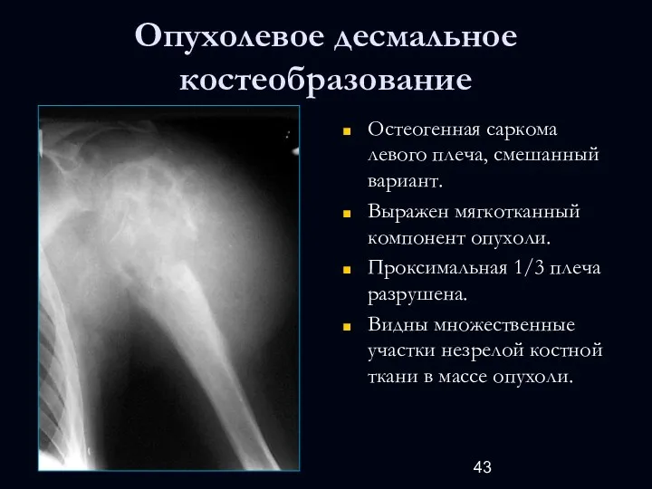 Опухолевое десмальное костеобразование Остеогенная саркома левого плеча, смешанный вариант. Выражен