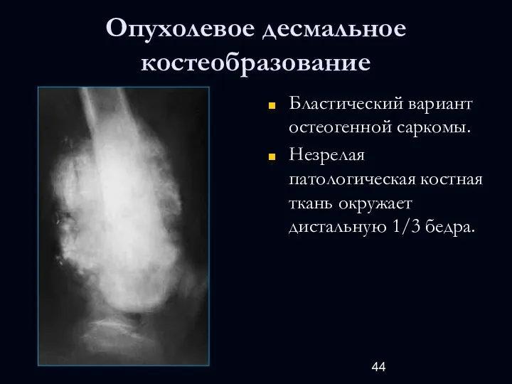 Опухолевое десмальное костеобразование Бластический вариант остеогенной саркомы. Незрелая патологическая костная ткань окружает дистальную 1/3 бедра.