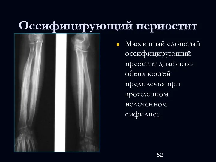 Оссифицирующий периостит Массивный слоистый оссифицирующий преостит диафизов обеих костей предплечья при врожденном нелеченном сифилисе.