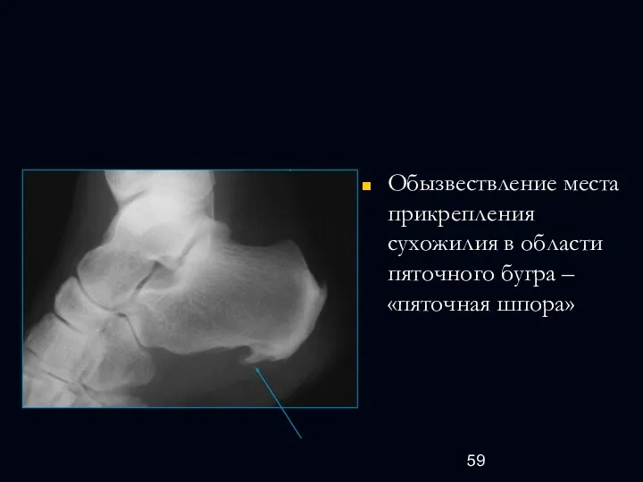 Обызвествление места прикрепления сухожилия в области пяточного бугра – «пяточная шпора»