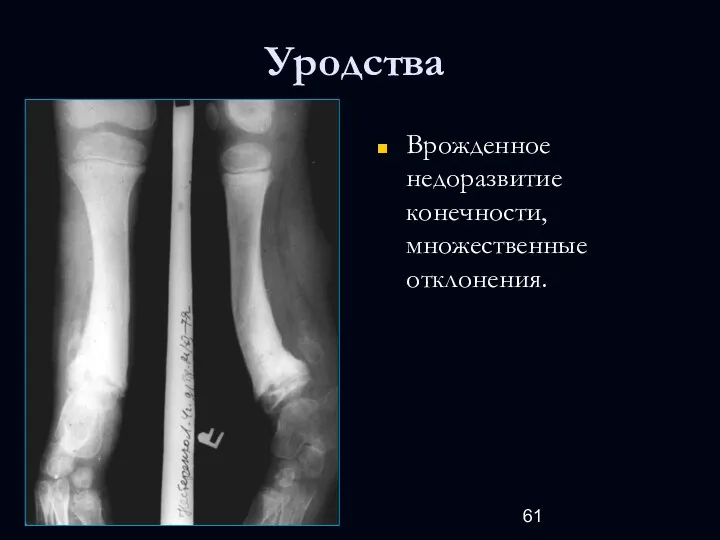 Уродства Врожденное недоразвитие конечности, множественные отклонения.