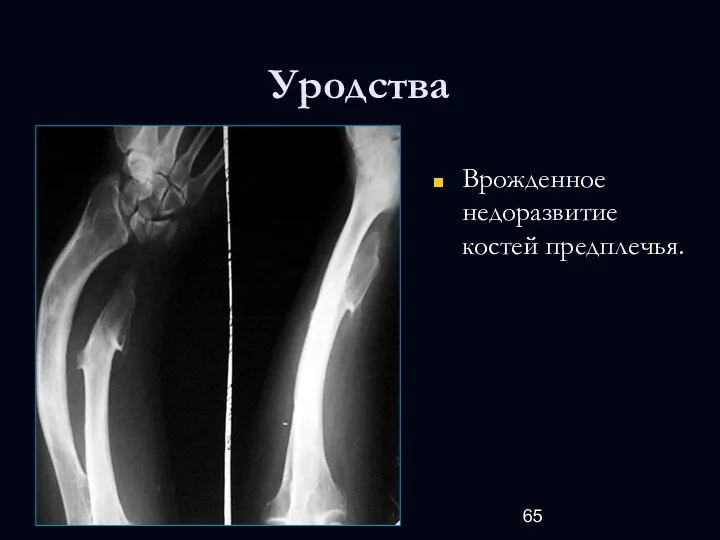 Уродства Врожденное недоразвитие костей предплечья.