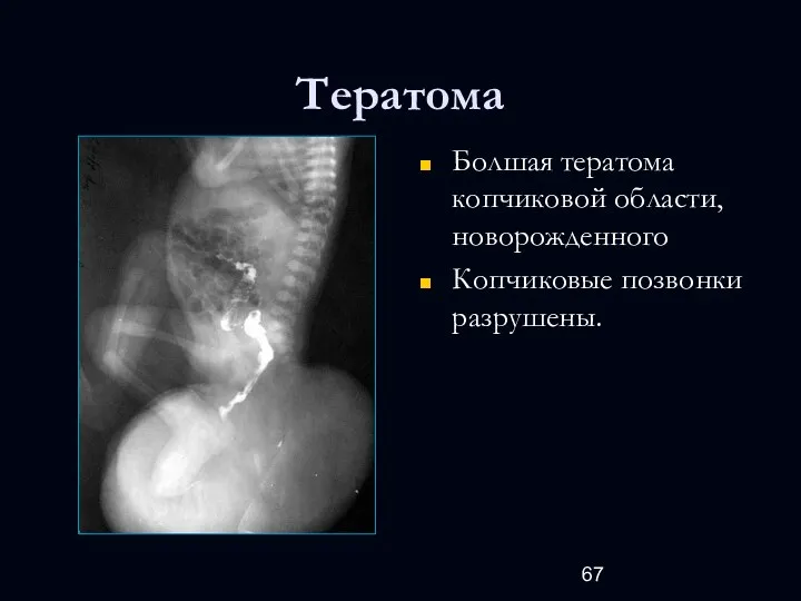 Тератома Болшая тератома копчиковой области, новорожденного Копчиковые позвонки разрушены.