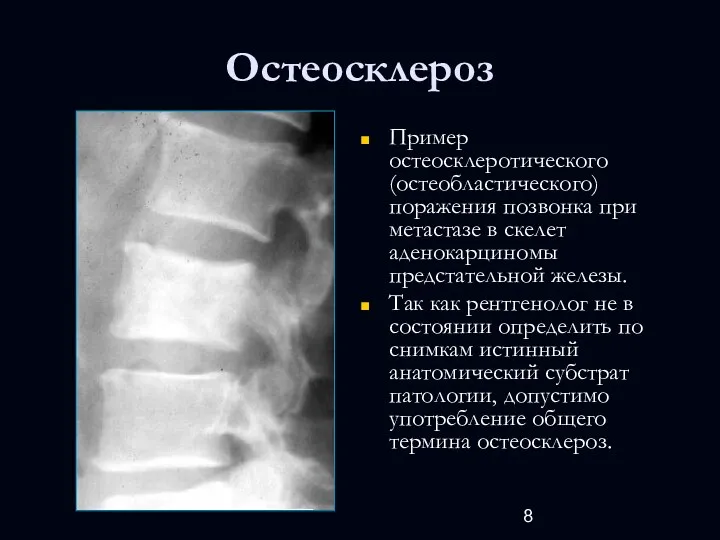 Остеосклероз Пример остеосклеротического (остеобластического) поражения позвонка при метастазе в скелет