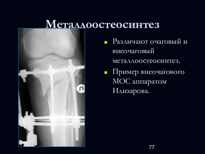 Металлоостеосинтез Различают очаговый и внеочаговый металлоостеосинтез. Пример внеочагового МОС аппаратом Илизарова.