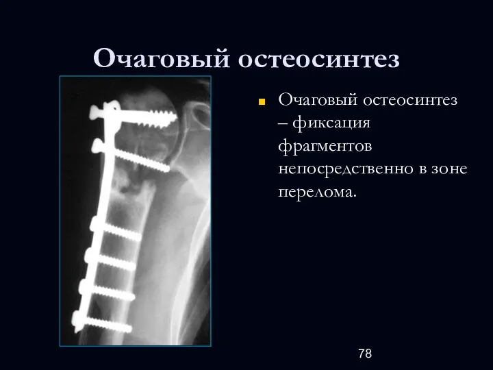 Очаговый остеосинтез Очаговый остеосинтез – фиксация фрагментов непосредственно в зоне перелома.