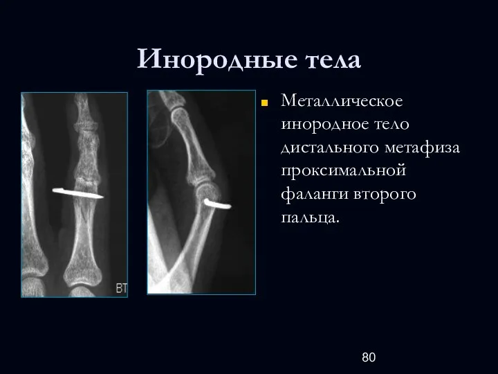 Инородные тела Металлическое инородное тело дистального метафиза проксимальной фаланги второго пальца.