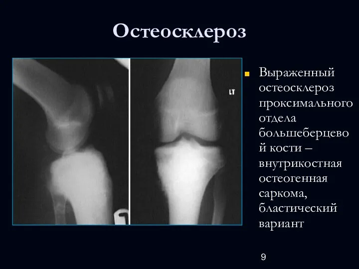 Остеосклероз Выраженный остеосклероз проксимального отдела большеберцевой кости – внутрикостная остеогенная саркома, бластический вариант