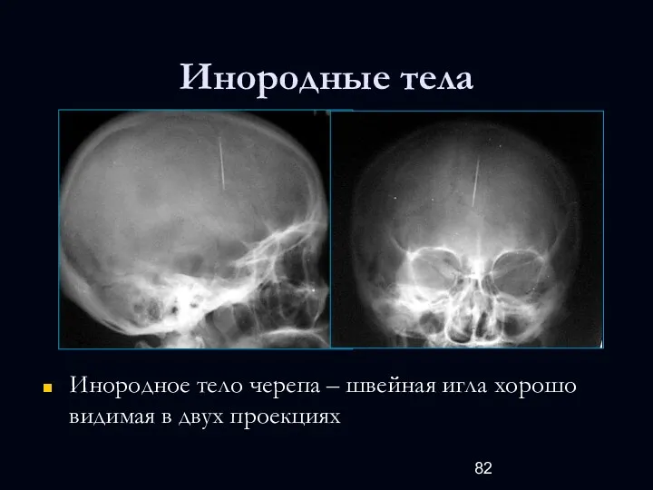 Инородные тела Инородное тело черепа – швейная игла хорошо видимая в двух проекциях