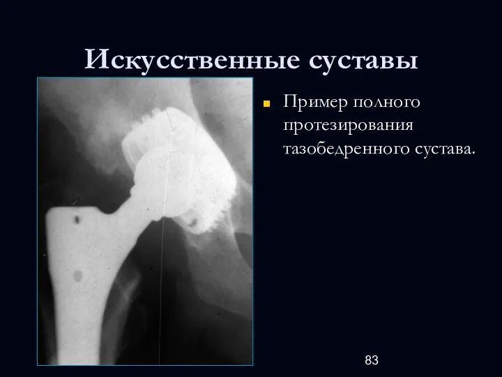 Искусственные суставы Пример полного протезирования тазобедренного сустава.