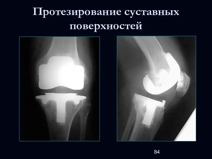 Протезирование суставных поверхностей