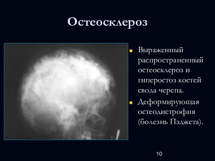 Остеосклероз Выраженный распространенный остеосклероз и гиперостоз костей свода черепа. Деформирующая остеодистрофия (болезнь Пэджета).