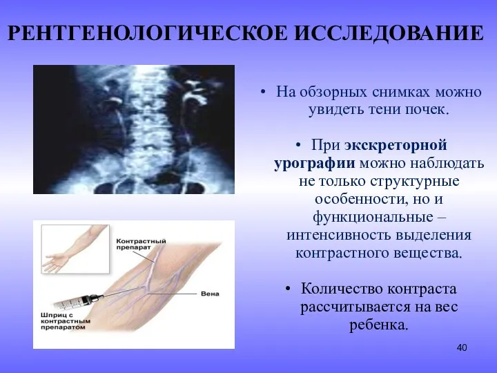 РЕНТГЕНОЛОГИЧЕСКОЕ ИССЛЕДОВАНИЕ На обзорных снимках можно увидеть тени почек. При