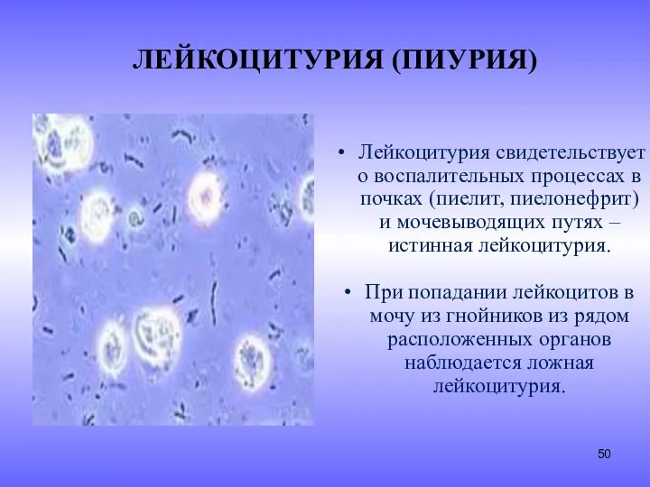 ЛЕЙКОЦИТУРИЯ (ПИУРИЯ) Лейкоцитурия свидетельствует о воспалительных процессах в почках (пиелит,