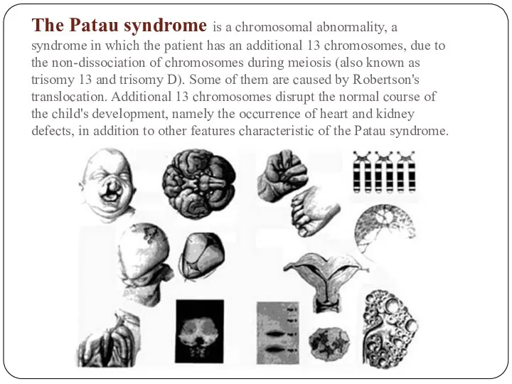 The Patau syndrome is a chromosomal abnormality, a syndrome in