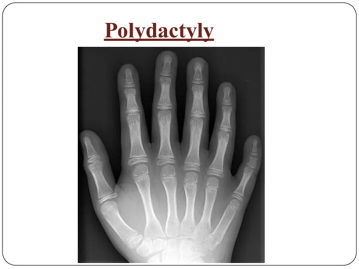 Polydactyly