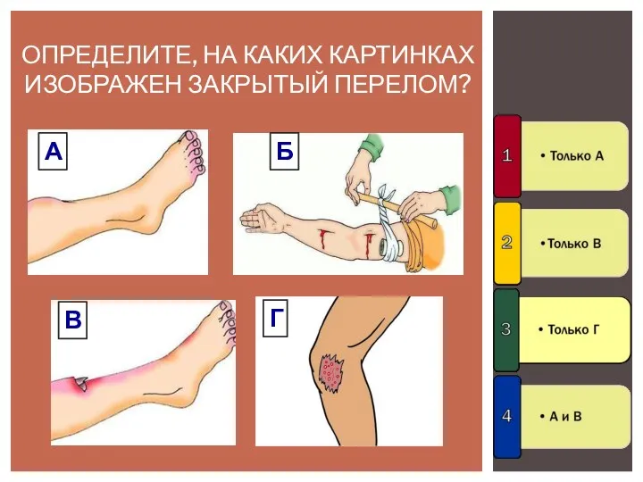 ОПРЕДЕЛИТЕ, НА КАКИХ КАРТИНКАХ ИЗОБРАЖЕН ЗАКРЫТЫЙ ПЕРЕЛОМ? Б В А Г