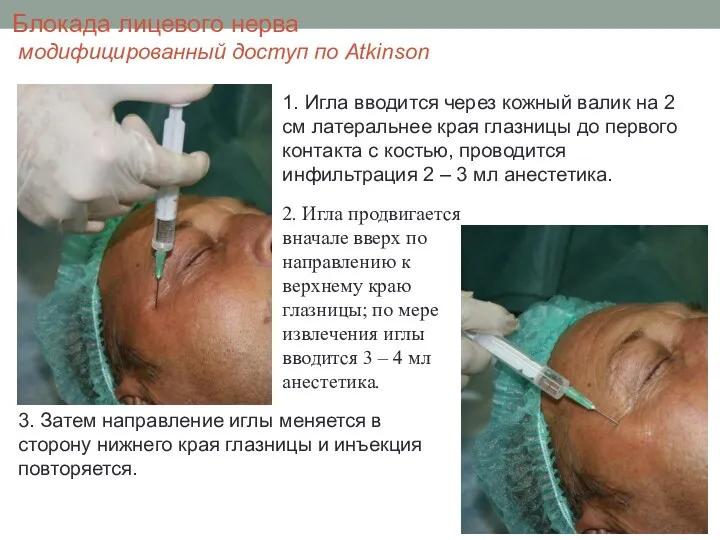Блокада лицевого нерва модифицированный доступ по Atkinson 3. Затем направление