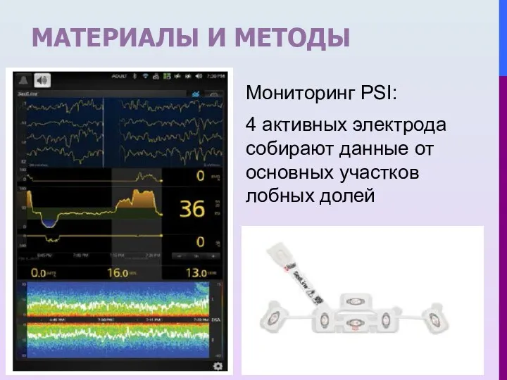 МАТЕРИАЛЫ И МЕТОДЫ Мониторинг PSI: 4 активных электрода собирают данные от основных участков лобных долей