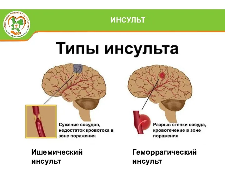 ИНСУЛЬТ Ишемический инсульт Геморрагический инсульт