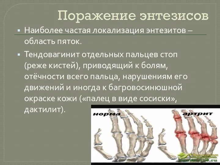 Поражение энтезисов Наиболее частая локализация энтезитов – область пяток. Тендовагинит