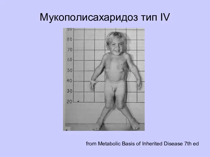 Мукополисахаридоз тип IV from Metabolic Basis of Inherited Disease 7th ed