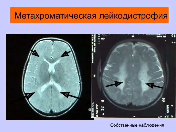 Метахроматическая лейкодистрофия Собственные наблюдения