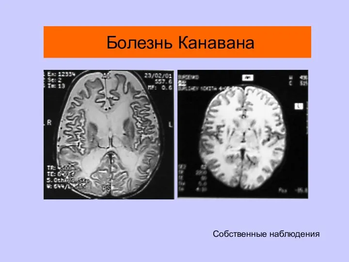 Болезнь Канавана Собственные наблюдения